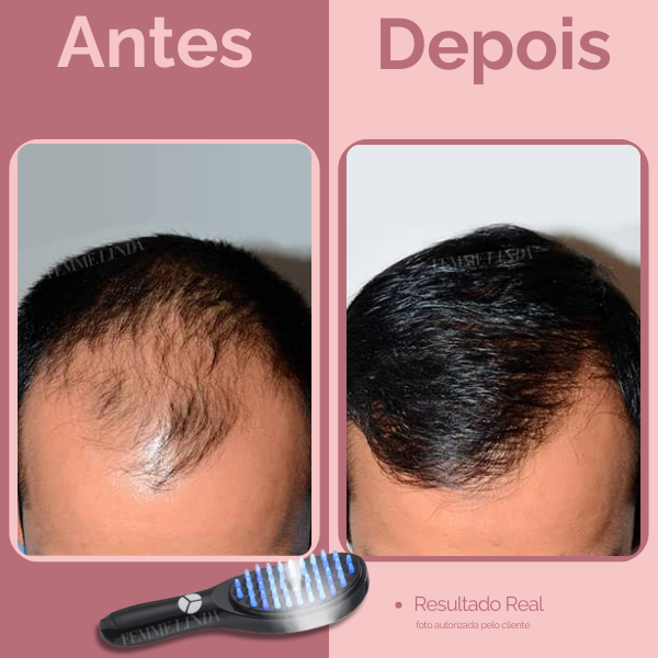 Escova de Terapia Capilar: LedBrush Smarts 4 em 1