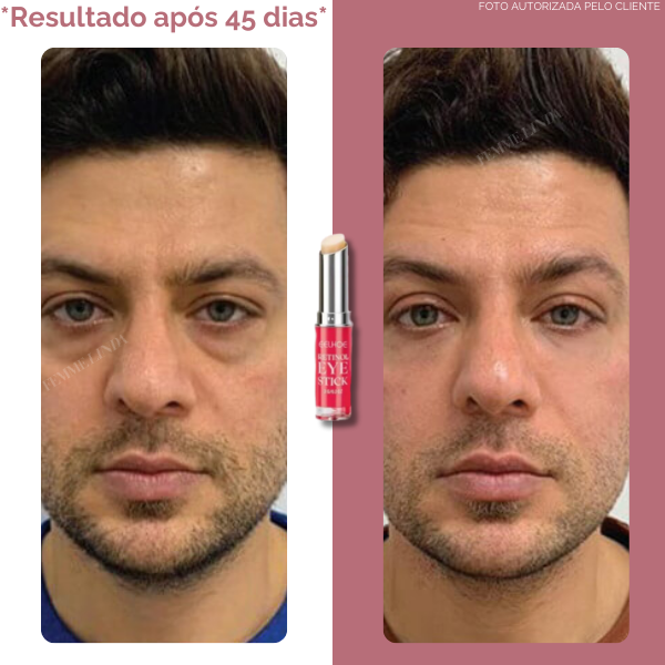 Femme Eye Stick: Bastão Anti-Olheiras e Anti-Idade com Retinol